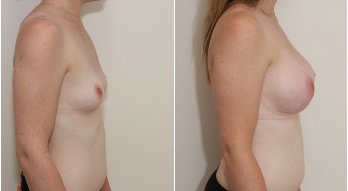 30s, 360g anatomical, moderate profile, submuscular placement.