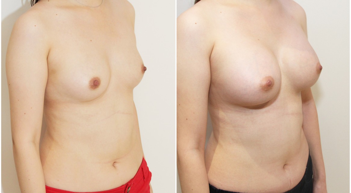 20s, 410g full projection anatomical implants, submuscular placement.