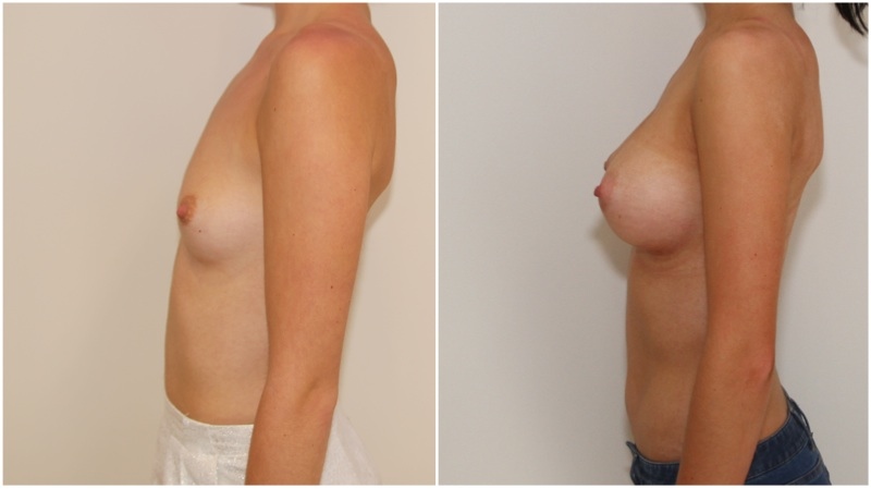 20s, shape creation with 470g extra high profile, dual plane 3, anatomical P-URE style implants.