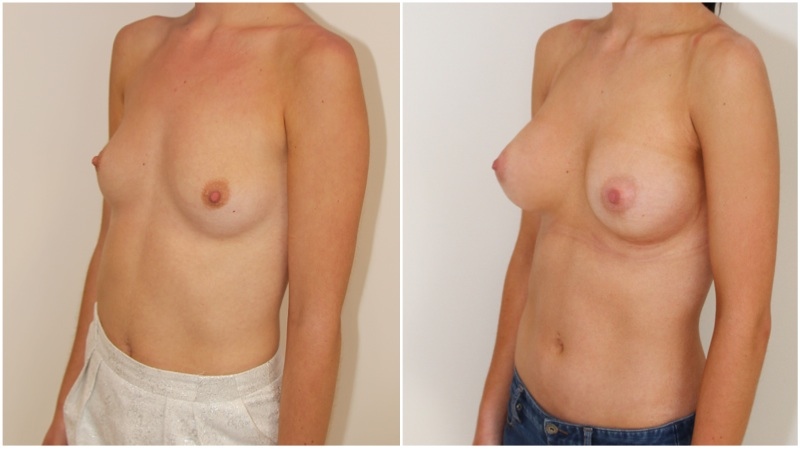 20s, shape creation with 470g extra high profile, dual plane 3, anatomical P-URE style implants.