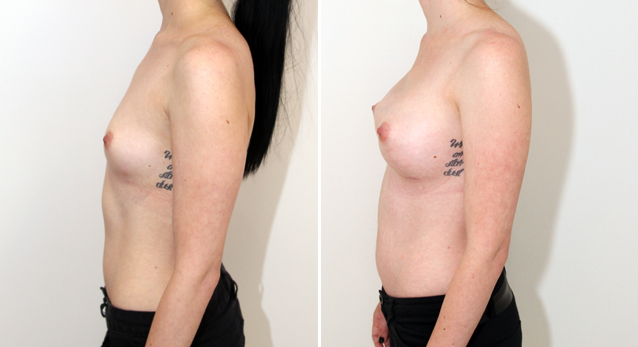 360g, P-URE style anatomical, dual plane positioning.