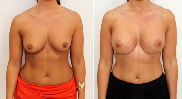 20s, subfascial placement, 330g mod plus profile anatomics.