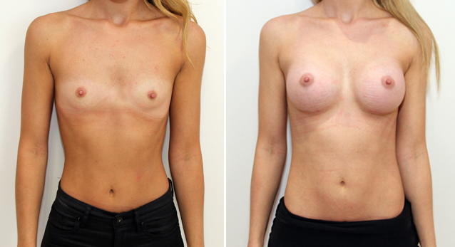20s, 255g anatomical memory gel implants, dual plane submuscular placement.