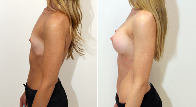 20s, 255g anatomical memory gel implants, dual plane submuscular placement.