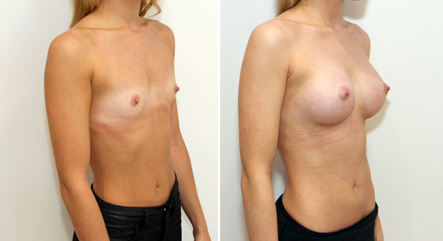 20s, 255g anatomical memory gel implants, dual plane submuscular placement.