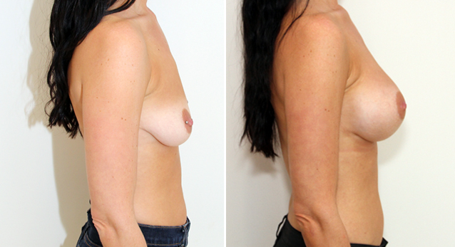 Enhanced style look created with 375cc, anatomical, dual-plane positioned, memory gel implants.