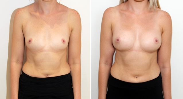 20s, 315g anatomical, moderate profile, dual plane positioned.