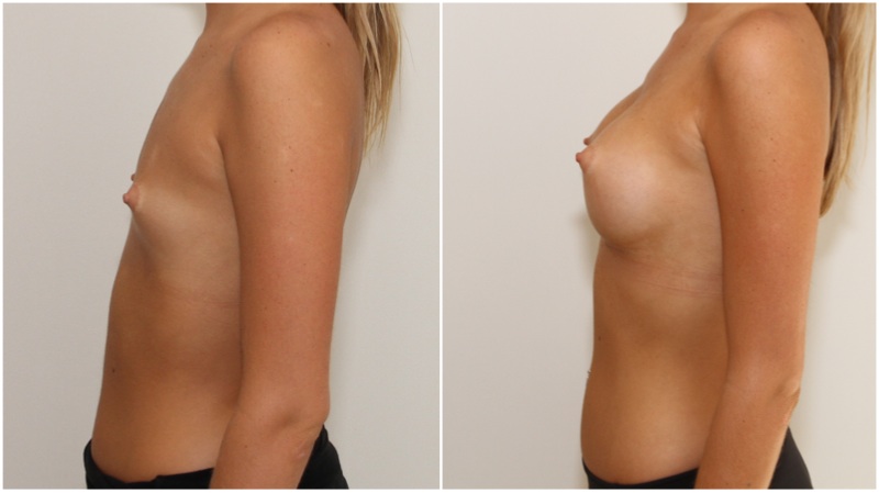 Early 20s, AA cup, minimal breast tissue ('blank palette'), natural shape created with 375g memory gel, anatomics.
