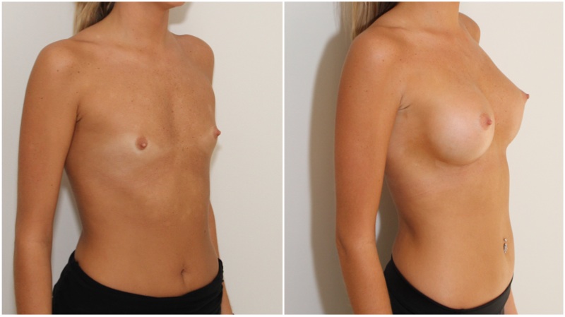 Early 20s, AA cup, minimal breast tissue ('blank palette'), natural shape created with 375g memory gel, anatomics.