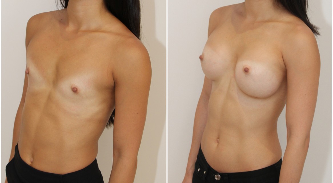 20s, dual plane 1, submuscular, 305g extra high profile, anatomical P-URE style, implants.