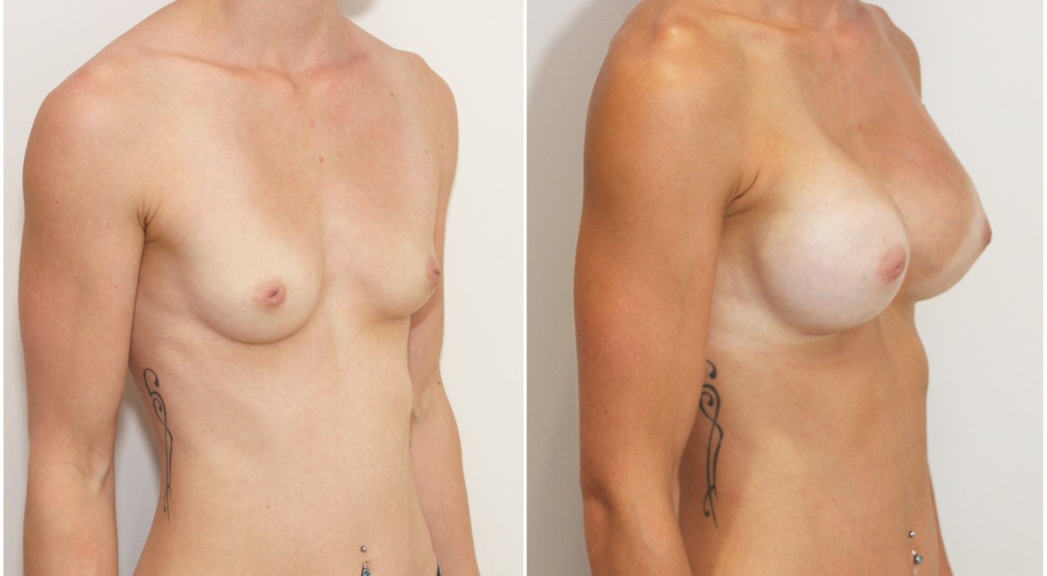 20s, athletic body, dual plane 2, anatomical 330g implants.