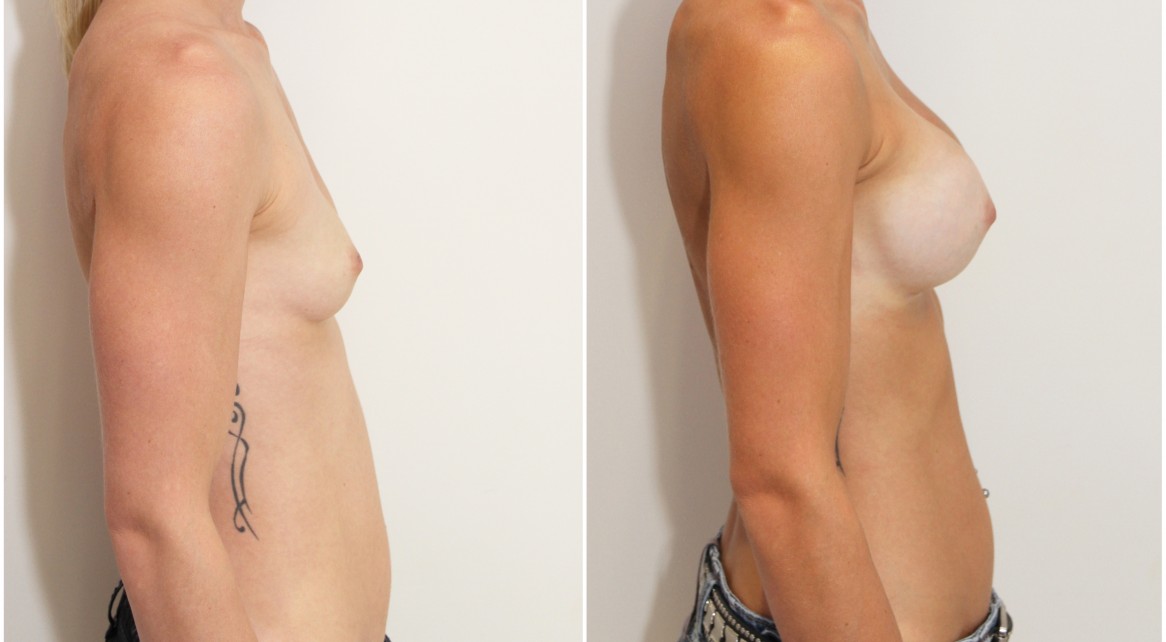 20s, athletic body, dual plane 2, anatomical 330g implants.