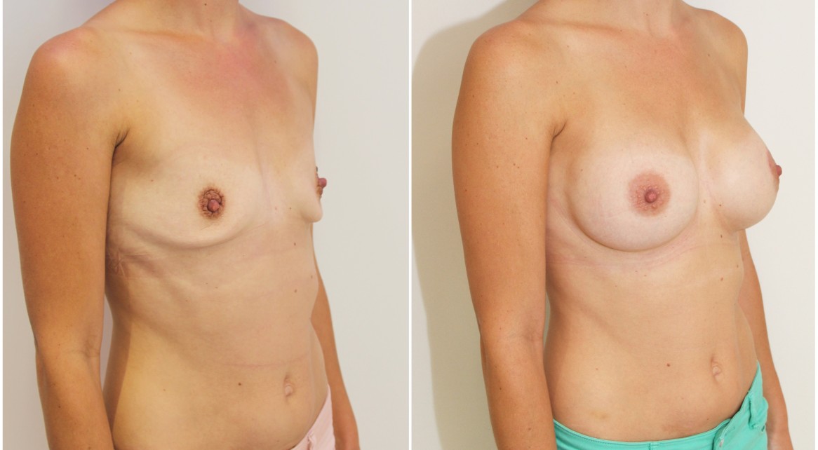 30s, 420cc moderate plus profile, high cohesive gel, anatomical implants, dual plane 2 placement. A crescentic periareolar lift has also been performed on the left side.