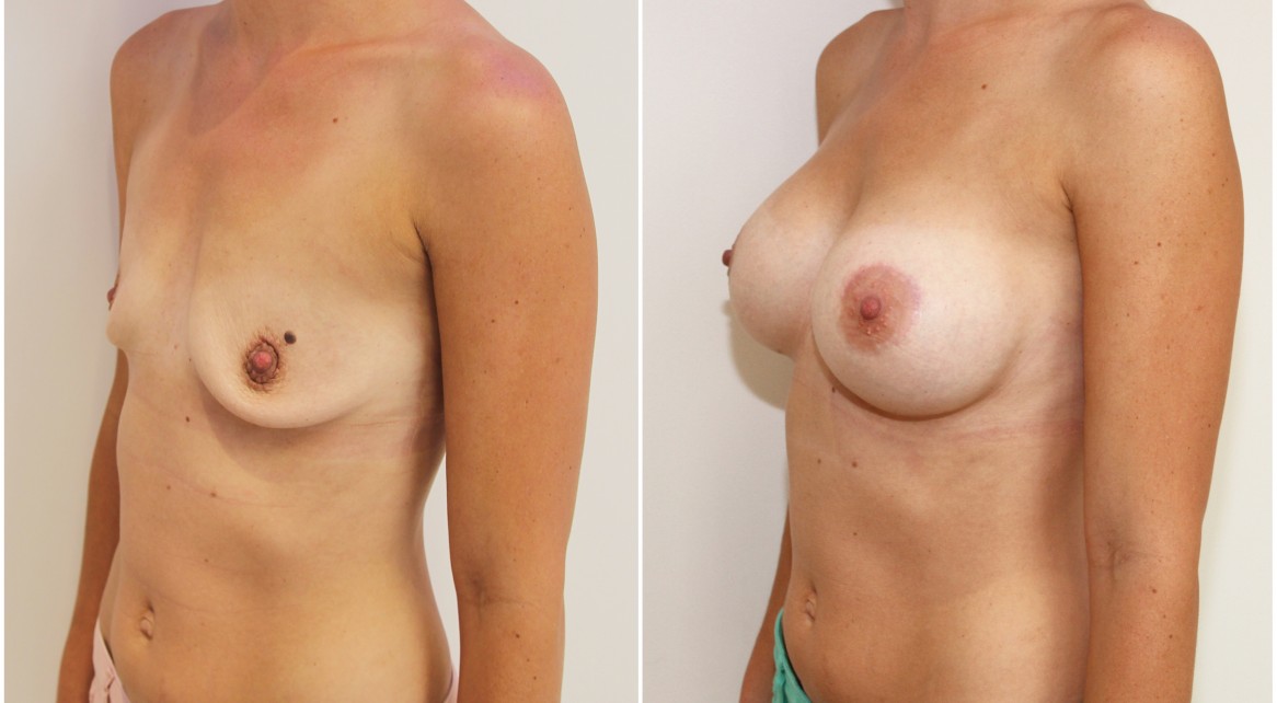 30s, 420cc moderate plus profile, high cohesive gel, anatomical implants, dual plane 2 placement. A crescentic periareolar lift has also been performed on the left side.