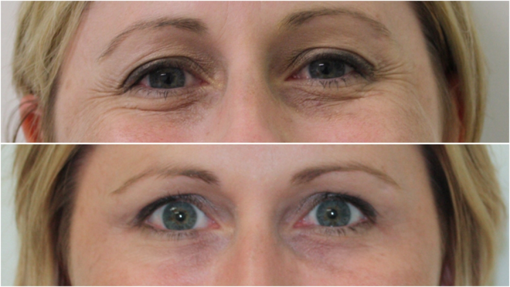 Early 30s, anti wrinkle injections to Crows' Feet and Glabellar.