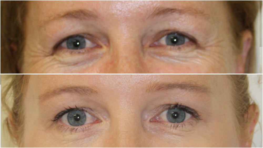 Early 40s, anti wrinkle injections to Crows' Feet and Glabellar.
