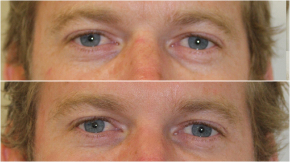 Early 30s, anti wrinkle injections to Crows' Feet and Glabellar.