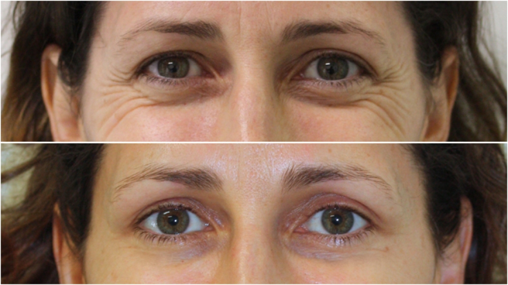 Early 40s, anti wrinkle injections to Crows' Feet and Glabellar.