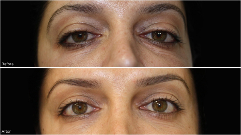 Anti muscle injections to the masseters (jaw muscles) to create a slimmer and more feminine jawline.