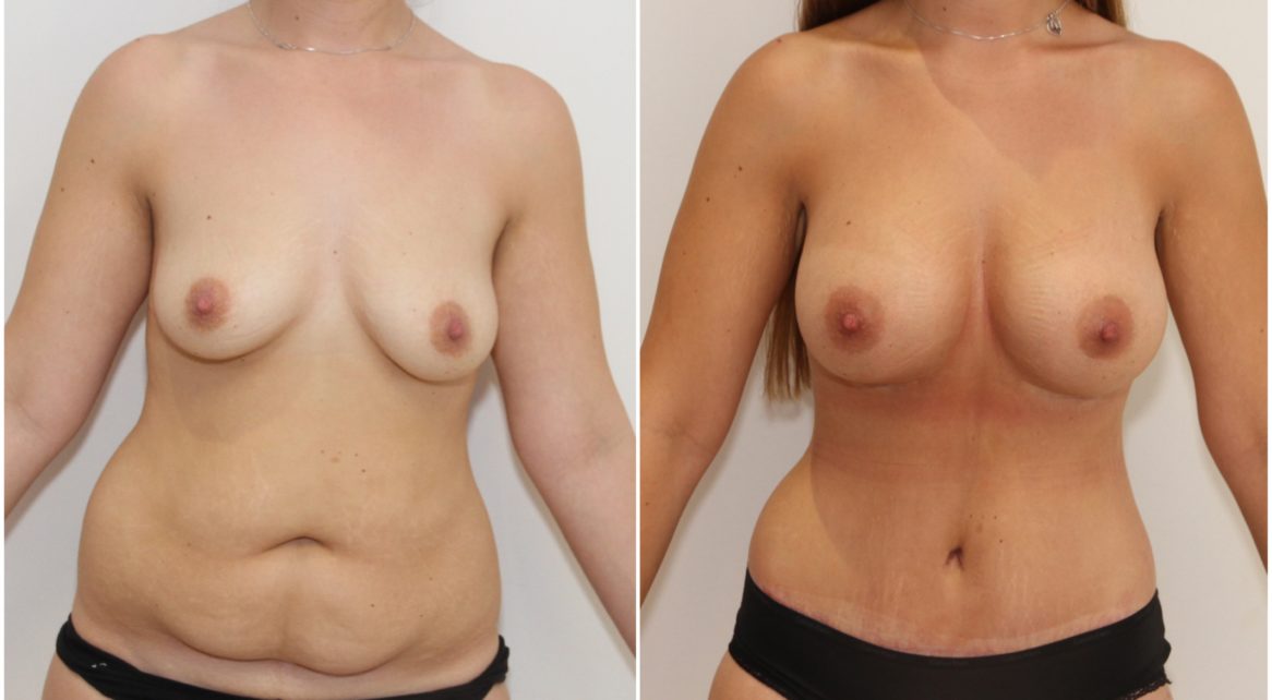 Breast augmentation combined with waist tightening tummy tuck (extended abdominolipoplasty)