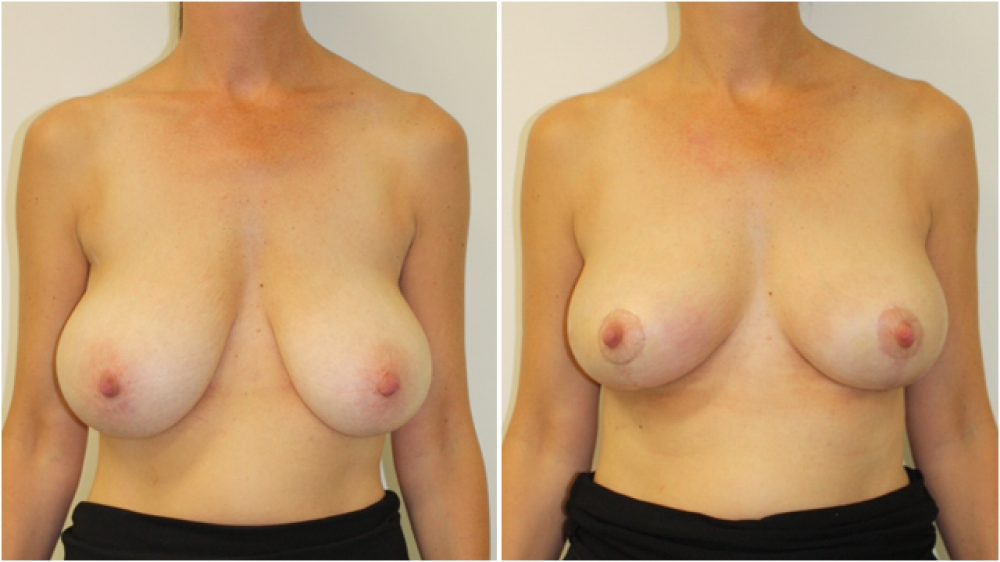 Early 40s, 1 child, vertical short scar breast lift (mastopexy) with nipple/areolar reshaping and repositioning.