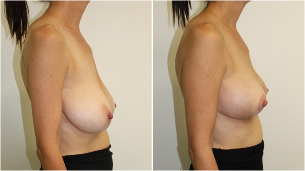 Early 40s, 1 child, vertical short scar breast lift (mastopexy) with nipple/areolar reshaping and repositioning.