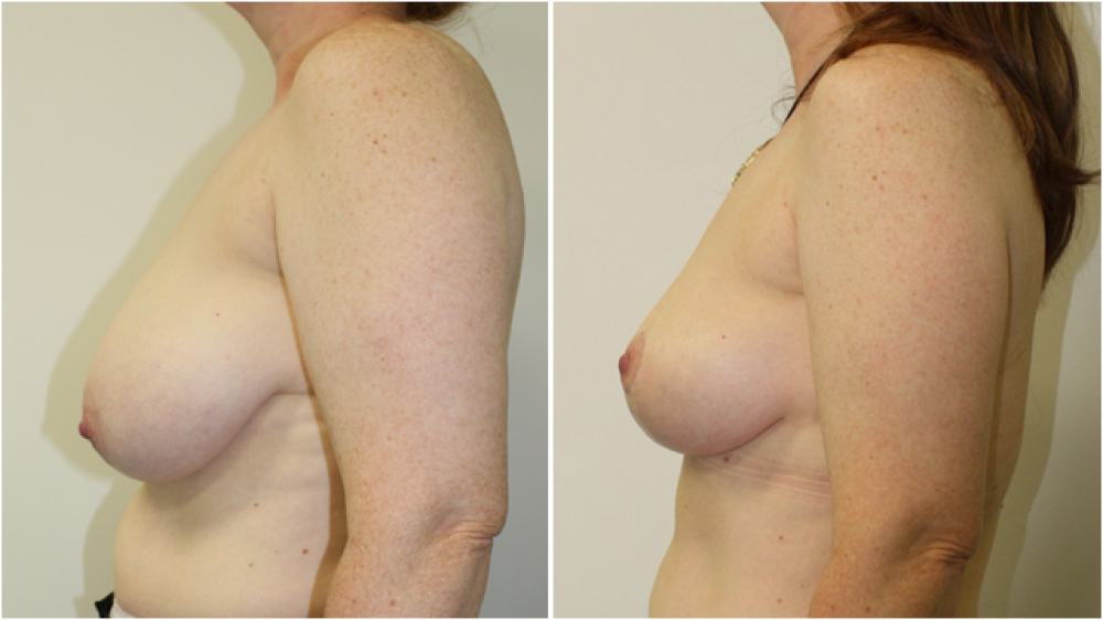 Late 40s, no children, vertical short incision breast lift (mastopexy) with nipple/areolar resizing and repositioning.