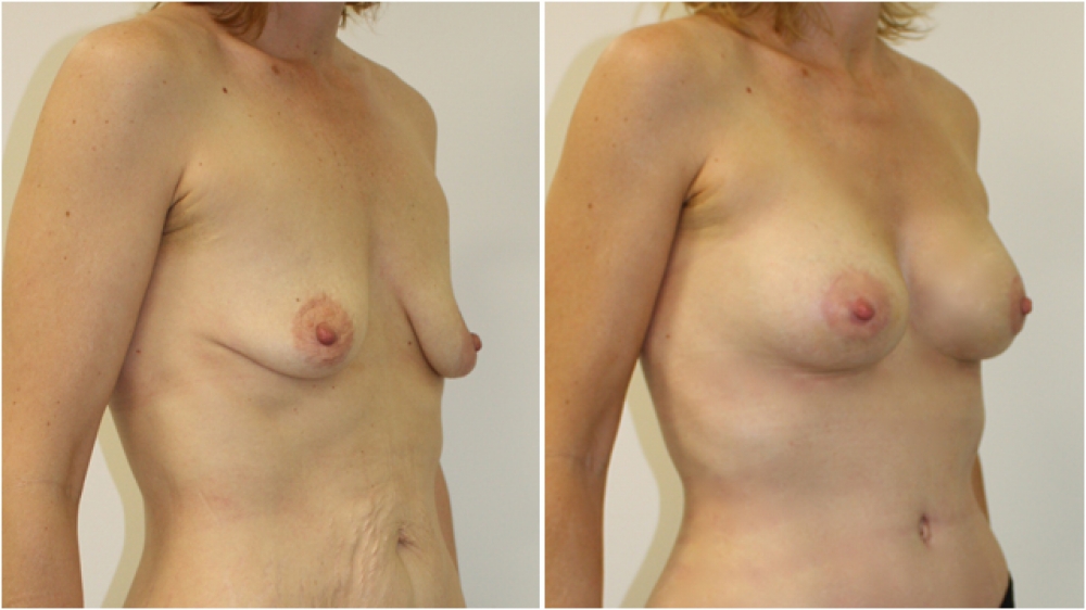 Early 40s, 4 children, periareolar lift combined with 245g anatomic (teardrop) moderate profile implants (augmentation mastopexy) and nipple/areolar repositioning.