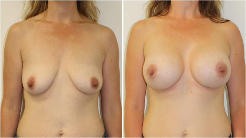 Late 30s, 3 children, crescentic periareolar breast lift combined with 360g extra high profile anatomical (teardrop) implants, subglandular placement.