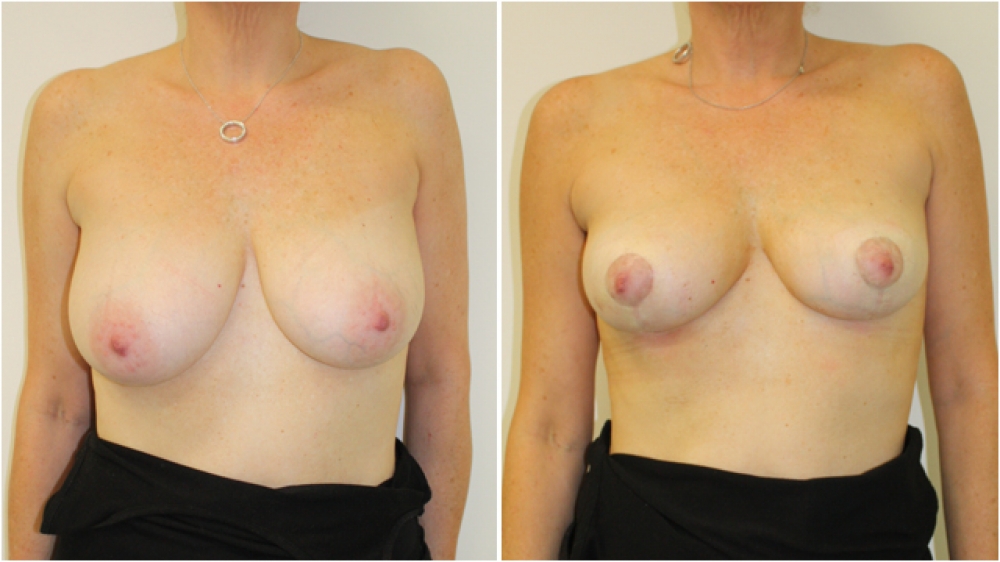 40s, children, breast asymmetry correction with a vertical breast lift.