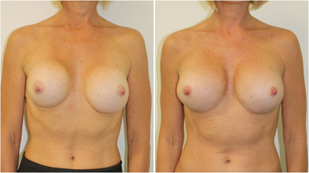 Early 40s, previous breast augmentation 10 years prior performed elsewhere with smooth round implants placed in a subglandular pocket. Wide cleavage, poor shape and capsular contracture corrected by Dr Miroshnik with 360g moderate profile, P-URE implants.