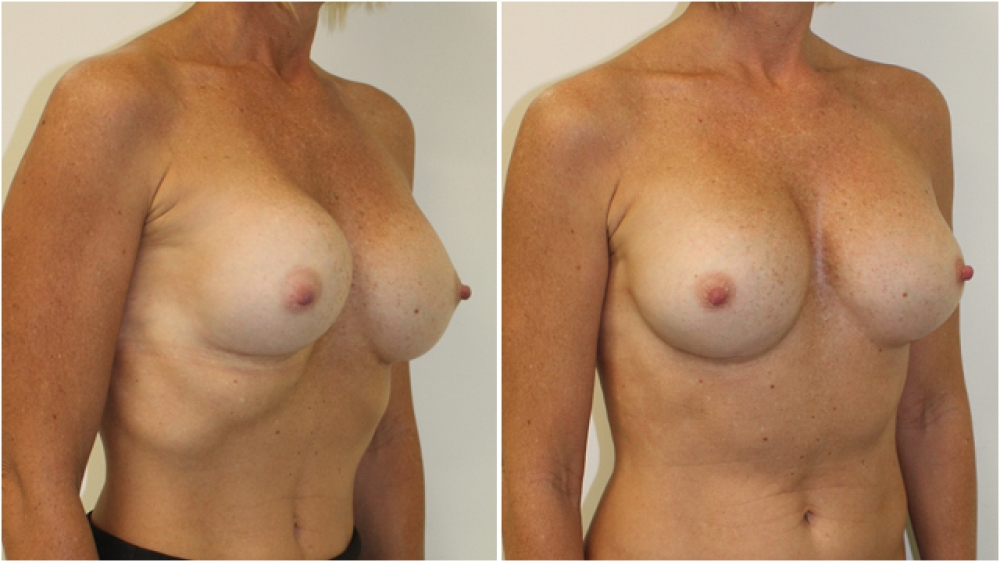 Early 40s, previous breast augmentation 10 years prior performed elsewhere with smooth round implants placed in a subglandular pocket. Wide cleavage, poor shape and capsular contracture corrected by Dr Miroshnik with 360g moderate profile, P-URE implants.
