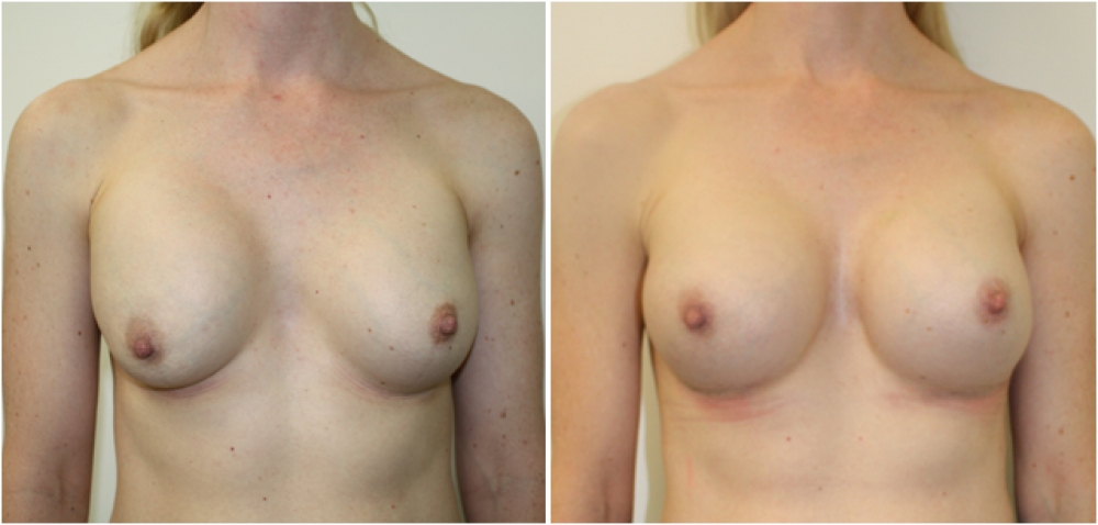 Late 30s, previous breast augmentation 10 years prior done elsewhere with smooth saline implants. Poor shape, malposition and capsular contraction corrected by Dr Miroshnik with neo-subpectoral placed, 425cc high profile, anatomical (teardrop) implants.
