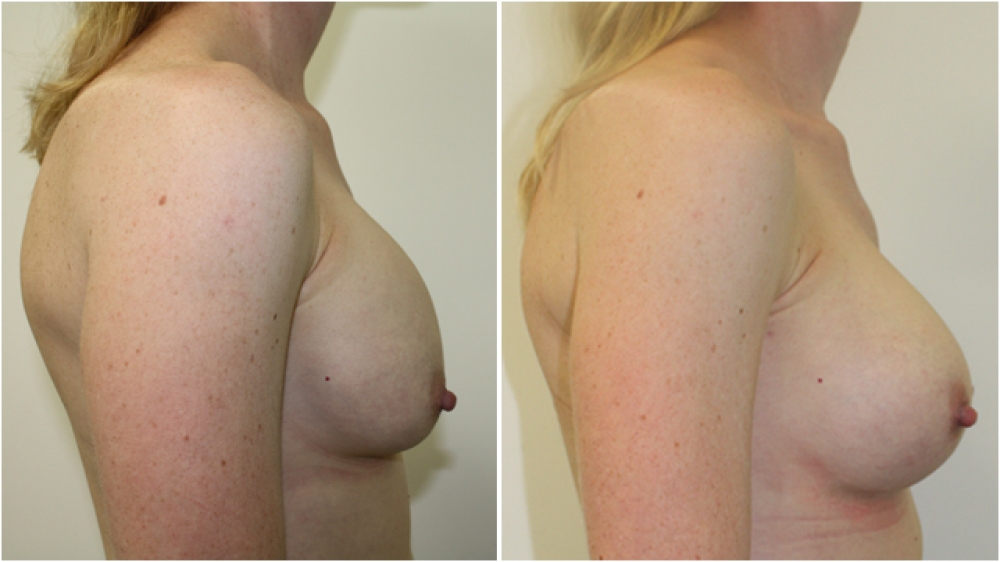 Late 30s, previous breast augmentation 10 years prior done elsewhere with smooth saline implants. Poor shape, malposition and capsular contraction corrected by Dr Miroshnik with neo-subpectoral placed, 425cc high profile, anatomical (teardrop) implants.
