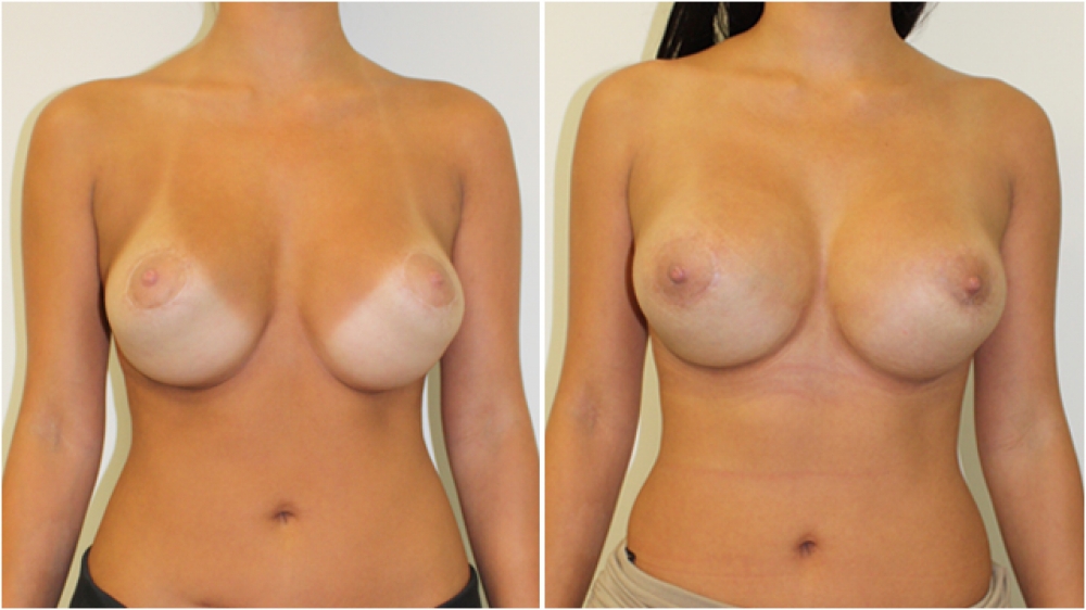 Late 20s, previous implants had 'bottomed out', creating a 'double bubble' appearance. Corrected by Dr Miroshnik with capsulorrhaphy and 315g moderate profile, polyurethane (P-URE) anatomical (teardrop) shaped implants.