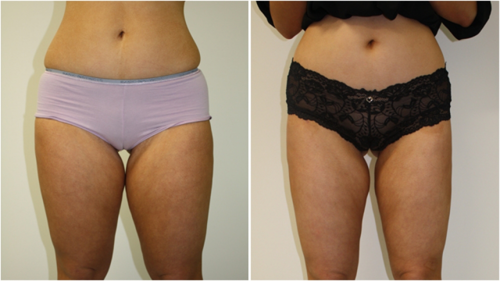 20s, female, liposuction to buttocks, thighs, flanks and tummy.
