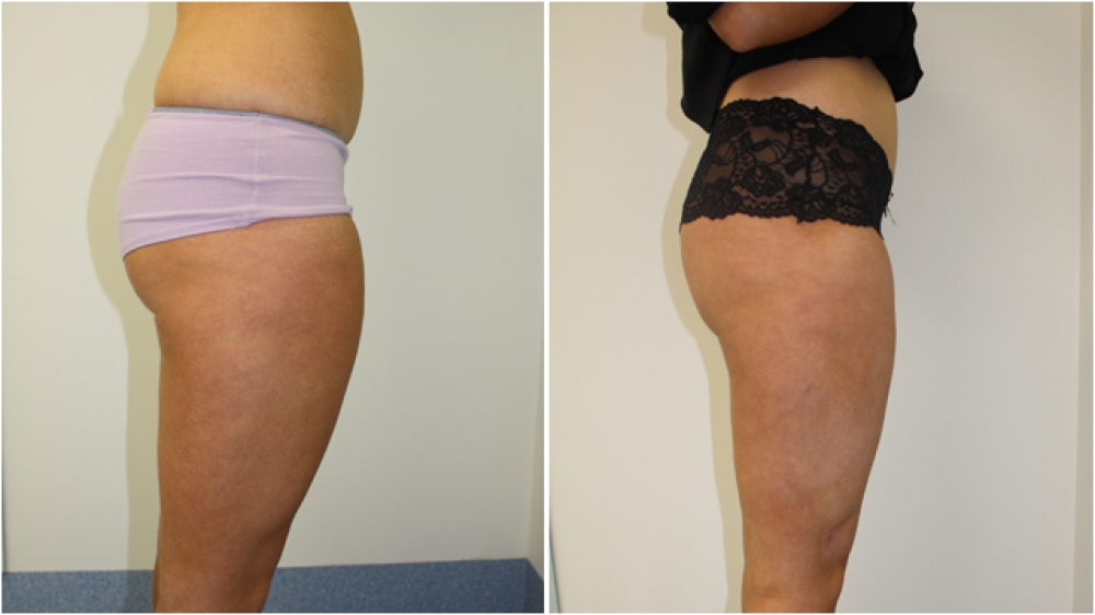 20s, female, liposuction to buttocks, thighs, flanks and tummy.