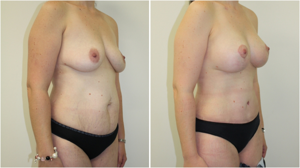 31 yo, 3 children, full tummy tuck (abdominoplasty) combined with breast lift + implants (augmentation mastopexy) to achieve a natural looking rejuvenation