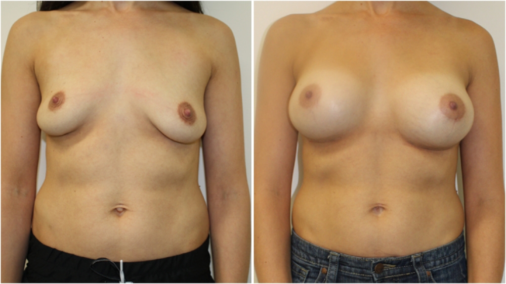 This 30 year old mother of 2 underwent concurrent breast augmentation and belly button reshaping surgery to achieve a more attractive appearance.