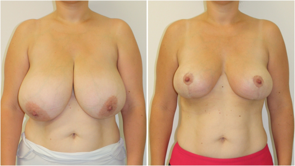 Late 30s, two children, vertical short-scar breast reduction and lift, nipple/areolar reshaping and repositioning, approx 500g breast tissue removed from each side.