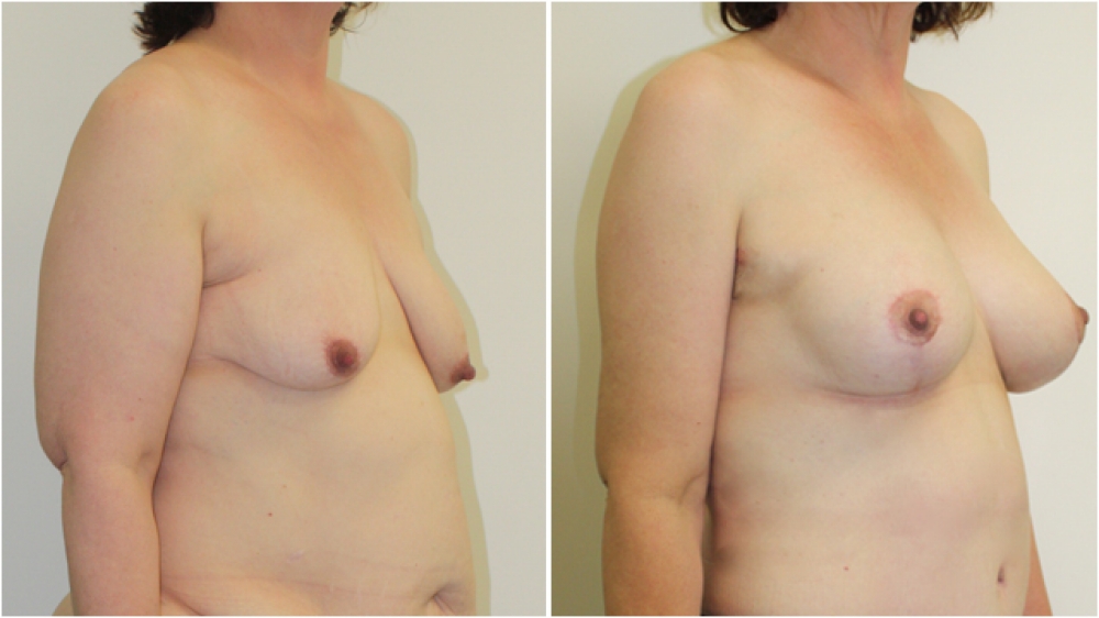 Early 50s, 2 children, recent large weight loss, vertical short- incision breast lift combined with 375g high projection teardrop implants