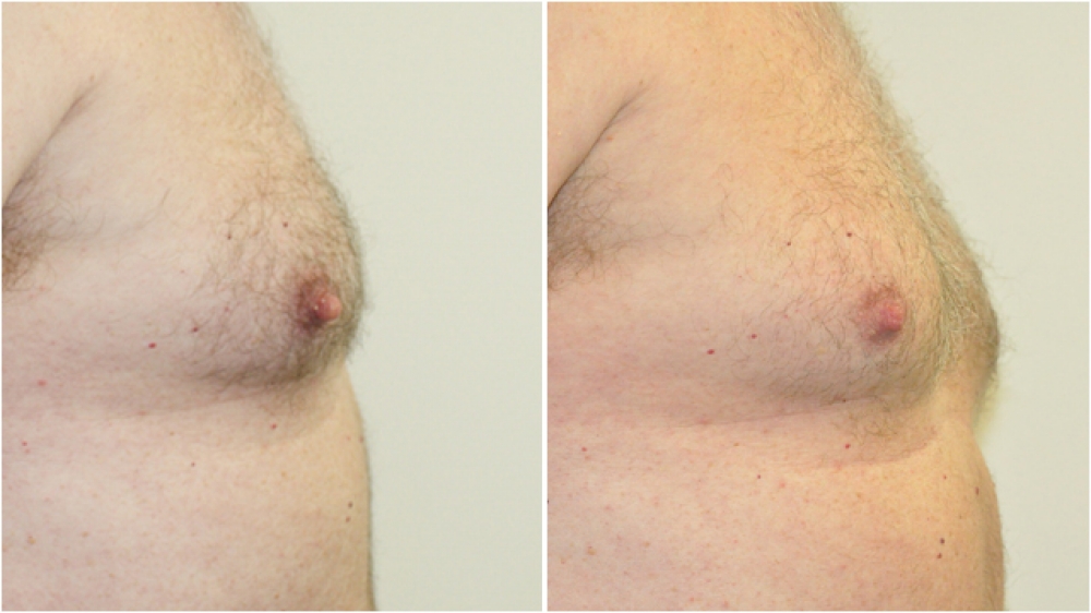 Mid 50s male, overtly large pointy nipples reduced in height and width for a more aesthetic male contour.