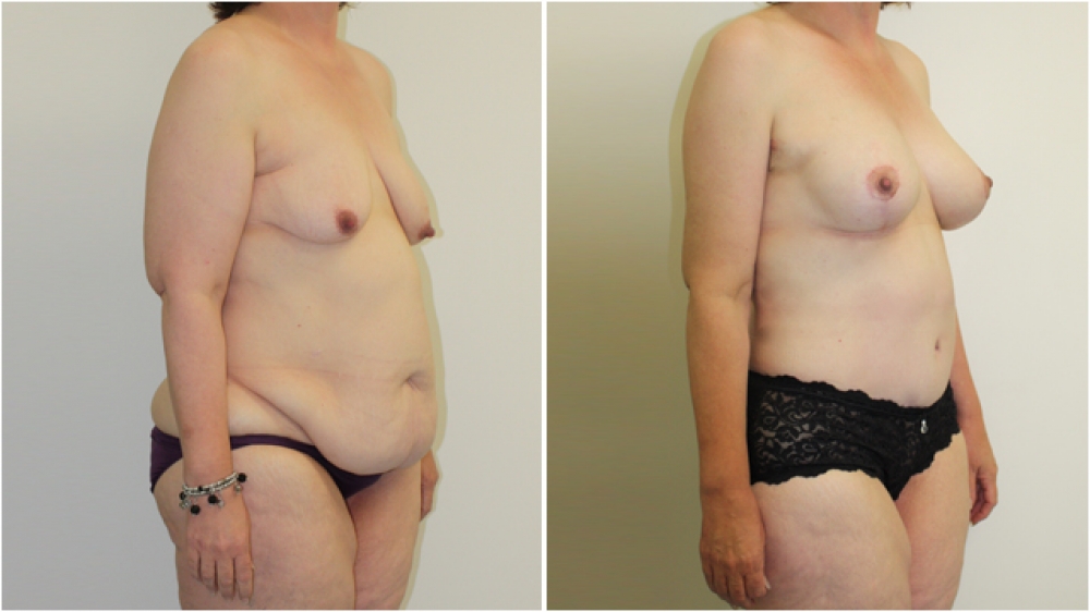 Early 50s, two children and large weight loss. Tummy tuck, arm lifts and breast augmentation/mastopexy procedures performed together for a dramatic result.