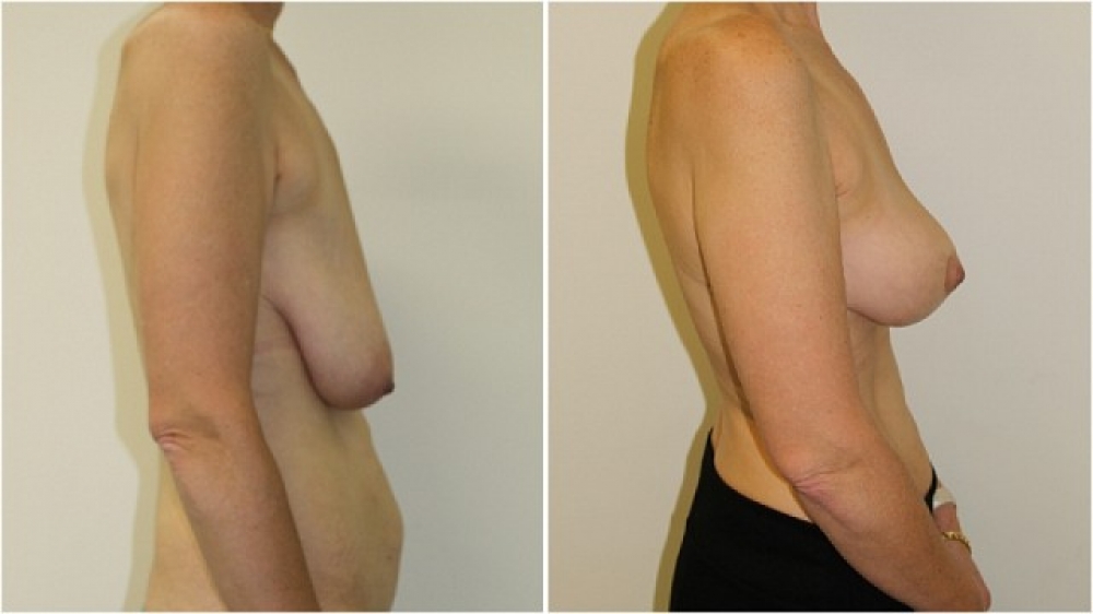 Late 40s, one child, vertical short-incision breast lift (mastopexy) and nipple/areolar reduction/repositioning.