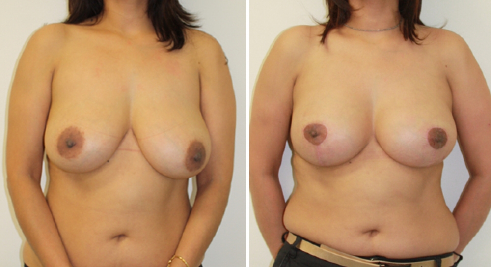 Early 40's, previous breast augmentation performed elsewhere with smooth saline implants. Poor shape and droop corrected by Dr Miroshnik with a revision augmentation (with 335g high profile teardrop shape implants) plus vertical short scar breast lift.