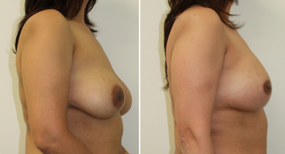 Early 40's, previous breast augmentation performed elsewhere with smooth saline implants. Poor shape and droop corrected by Dr Miroshnik with a revision augmentation (with 335g high profile teardrop shape implants) plus vertical short scar breast lift.