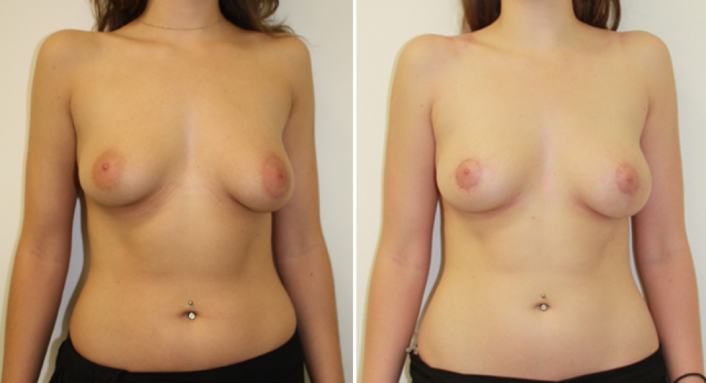 Early 20's, no children, dissatisfied with shape and size of nipple areola complex. Benelli breast lift performed by Dr Miroshnik to correct shape and symmetry.