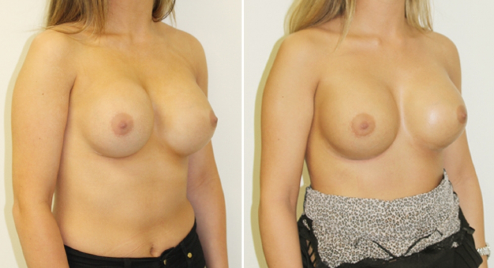 Early 20's, original augmentation surgery performed elsewhere. Removal/capsulectomy and replacement of both breast implants by Dr Miroshnik to improve shape and consistency after capsular contracture.