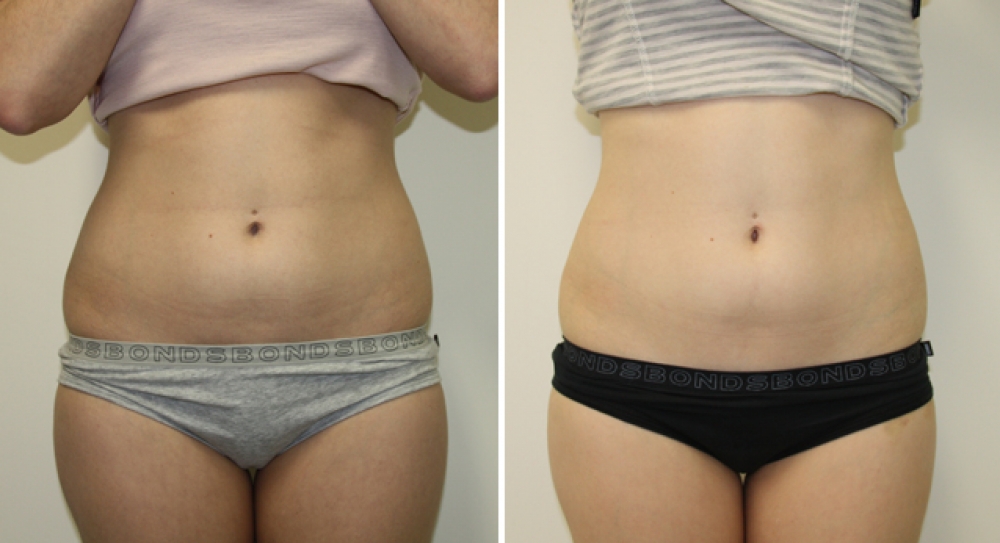 25yo, F, series of 4 Exilis treatments to tummy and love handle area.