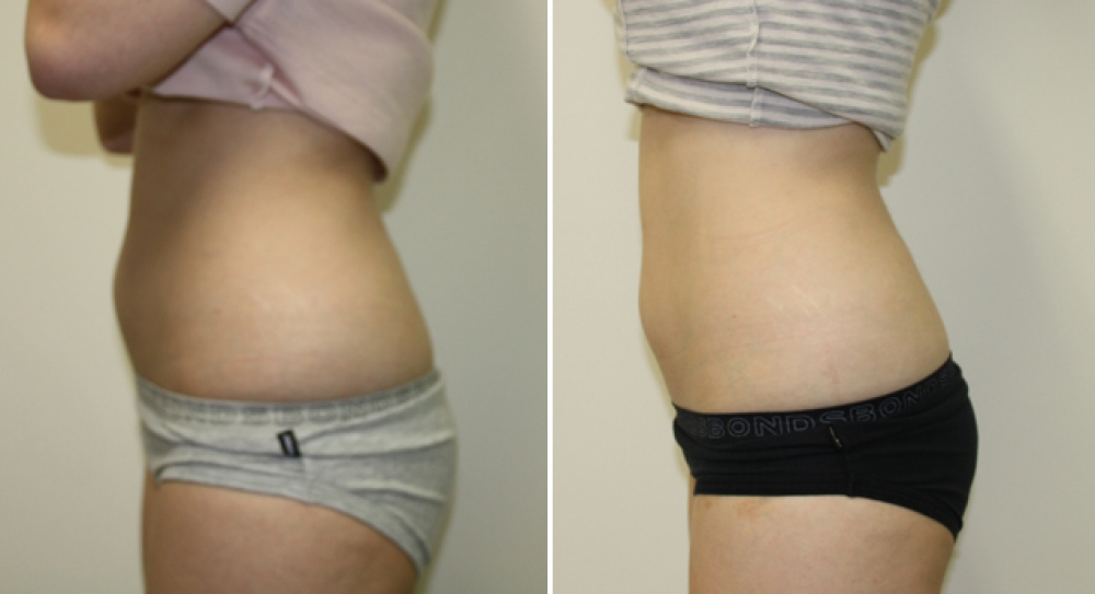 25yo, F, series of 4 Exilis treatments to tummy and love handle area.